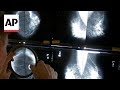 Mammograms should start at 40, panel says