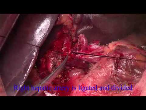 Right Hepatectomy with Portal Vein Reconstruction for Hilar Cholangiocarcinoma