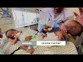 WARNING: GRAPHIC CONTENT: Gazas premature babies bound for Egypt after evacuation  - 02:54 min - News - Video
