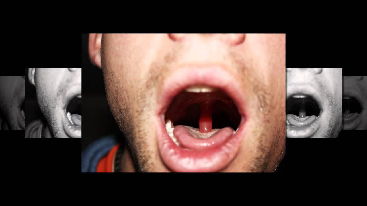 Got Red Uvula Lets See How It Looks Youtube