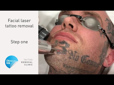Laser Tattoo Removal of face tattoo 13 'Lucky for some'