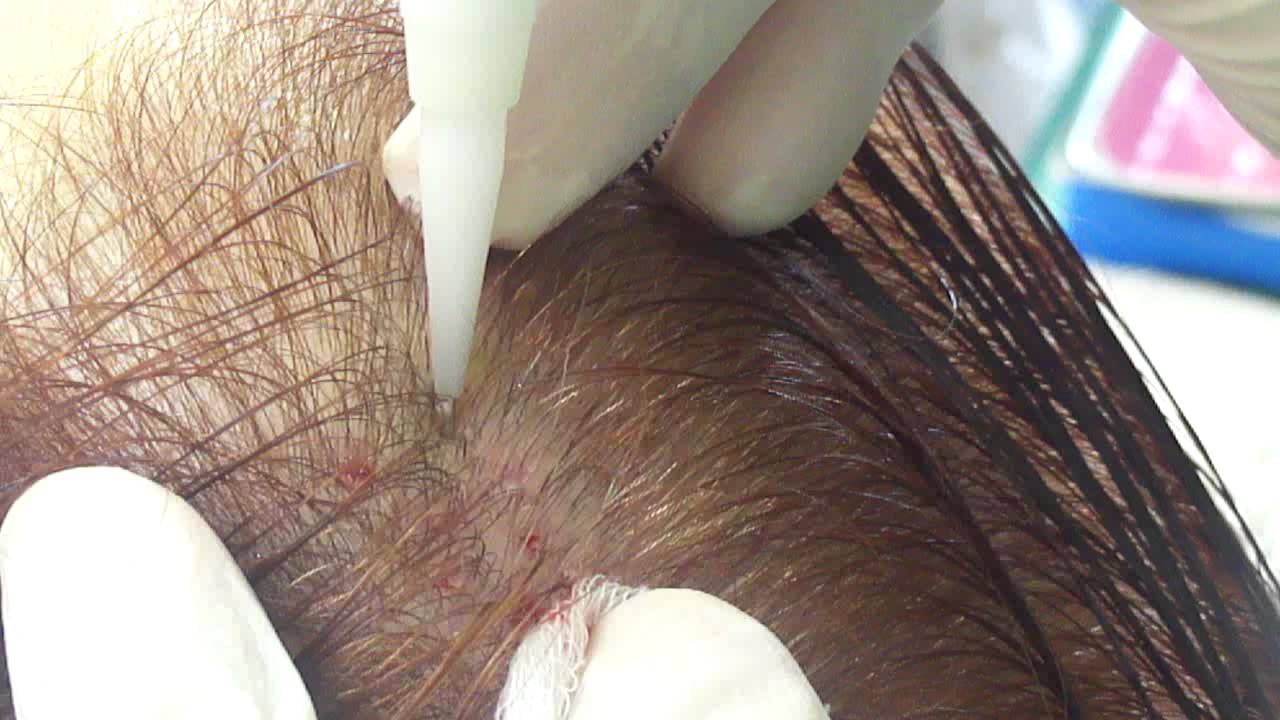 Fue Hair Transplantation Unshaven Dr Anastasios Vekris Video Youtube 3806