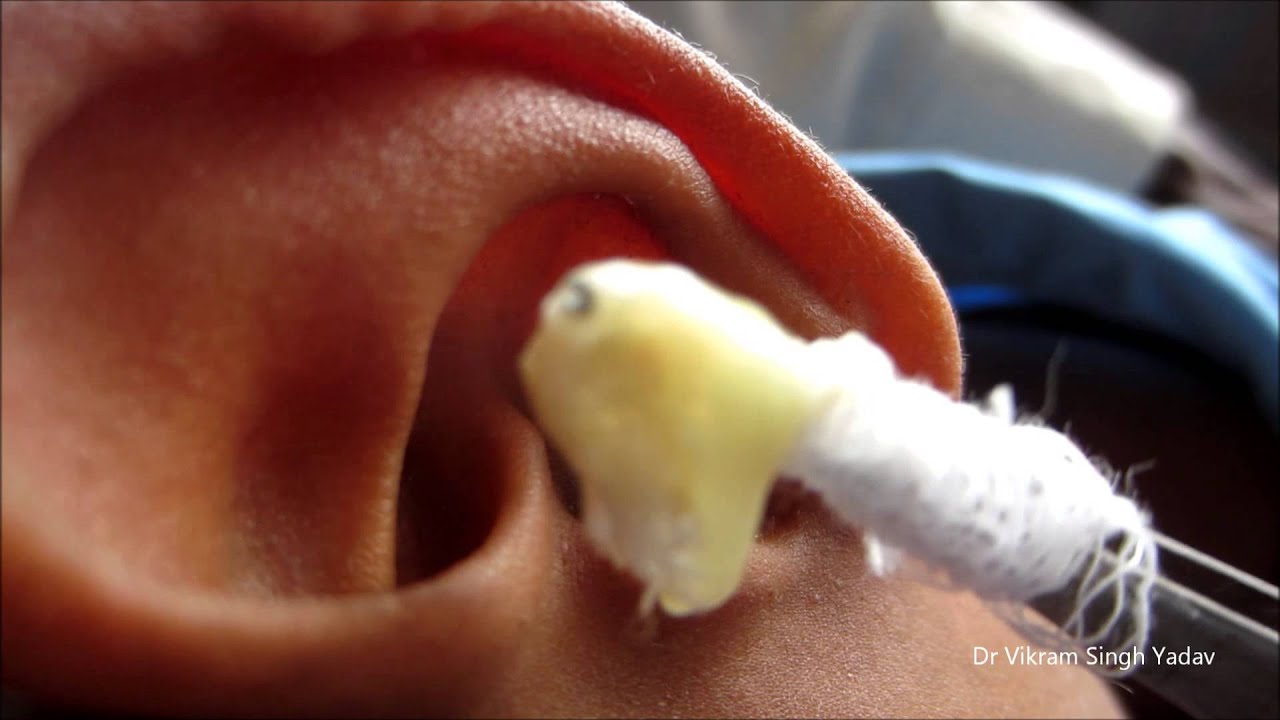 Acute Ear Infection / Ear Discharge - Causes FAQs