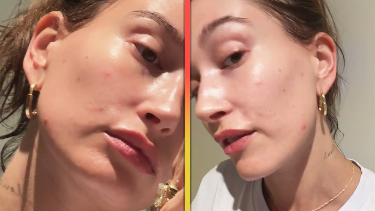 Hailey Bieber Goes Filter-Free to Show Her Pimples
