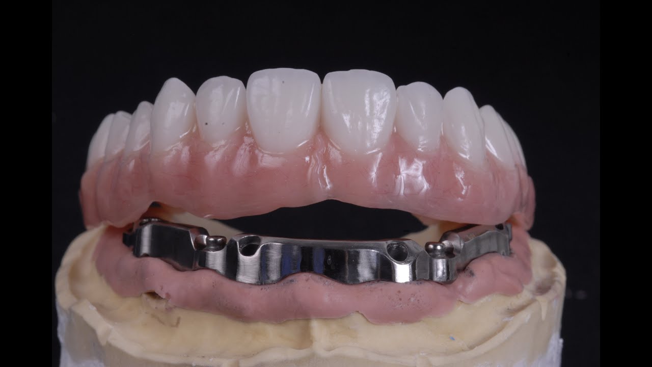 All On 4 Implant Bar Supported Denture Youtube