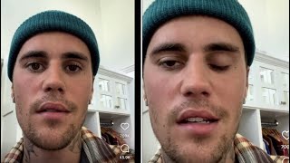 Justin Bieber REVEALS HALF OF HIS FACE Is Temporarily PARALYZED After Being Diagnosed Ramsay Hunt