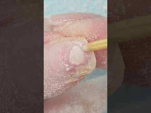 Removing Lifts WITHOUT PAIN!