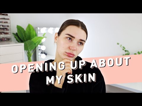 Opening Up About My Skin + Skincare Routine