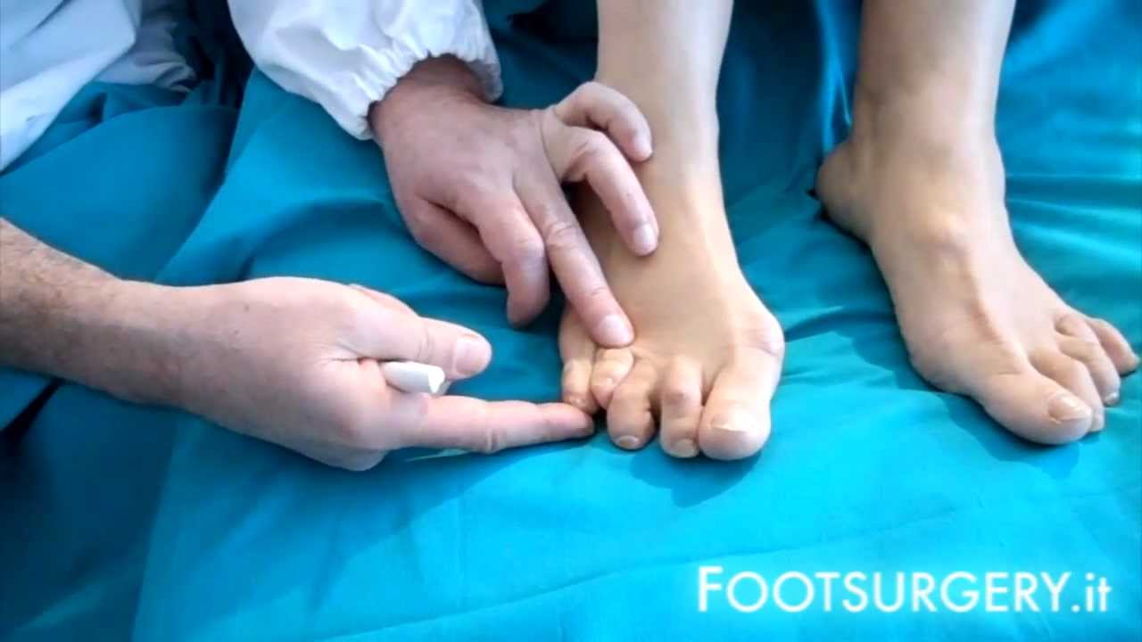 Dito a martello: esercizi e rimedi - Cure-Naturali.it