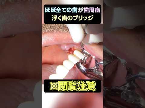 ※閲覧注意💦ほぼ全ての歯が歯周病でした...【前編】 #歯医者  #dentist #奥歯　#歯石除去 #歯石 #tartar #ショート #shorts