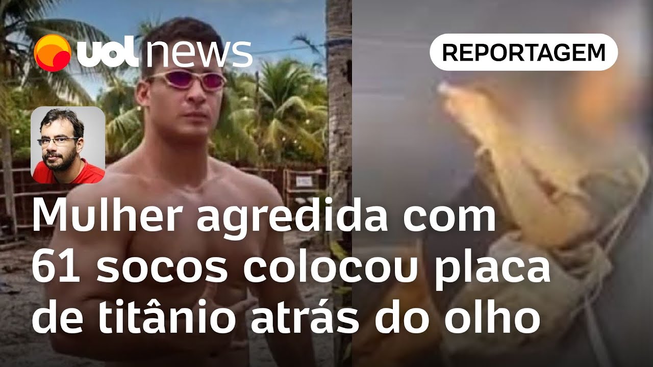 Mulher agredida com 61 socos colocou placa de titânio atrás do olho em reconstrução da face
