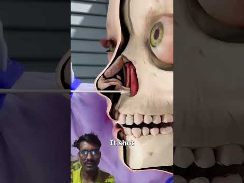 Girl survives blow dart in skull😨