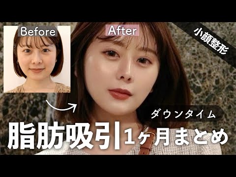 【小顔整形】顔がちっちゃくなった！脂肪吸引と糸リフト1ヶ月経過まとめ👩🏻リアルレポお届けします✨