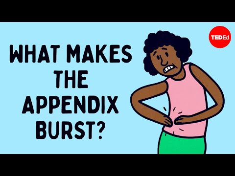 What does appendix pain feel like? - David R. Flum