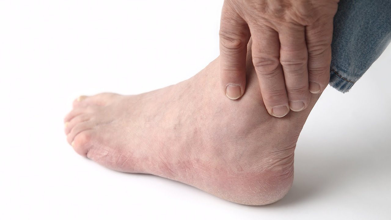 gout symptoms foot picture