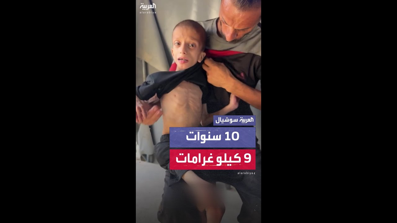 طفل بغزة بعمر الـ 10 سنوات يزن 9 كيلو غرامات ويعاني من سوء التغذية الحاد