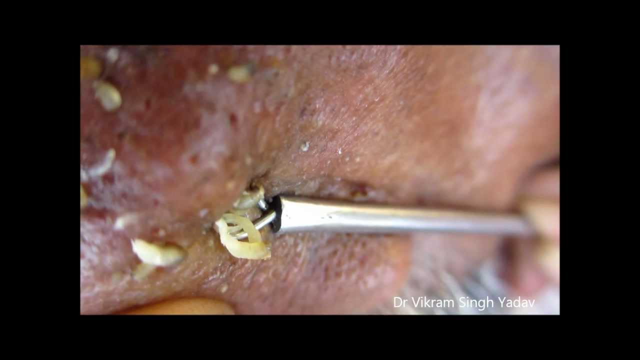 Junction nevus | definition of junction nevus by Medical ...