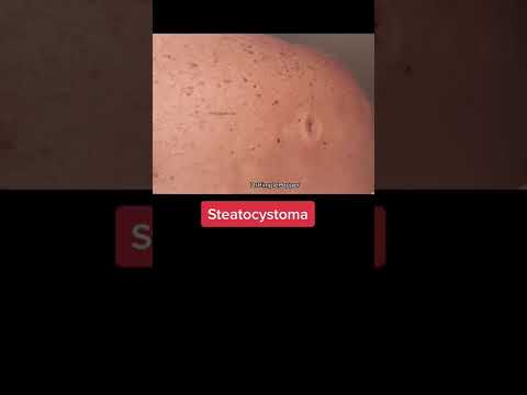 Dropping some knowledge on sebaceous cysts 👩🏻 🔬 #drpimplepopper #popaholics