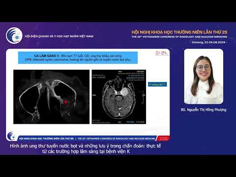 2. Hình ảnh ung thư tuyến nước bọt phụ và những lưu ý trong chẩn đoán (BS. Nguyễn Thị Hồng Phượng)