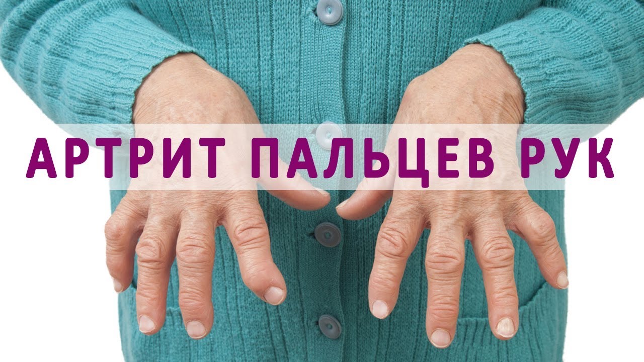 Лечение артрита рук препараты