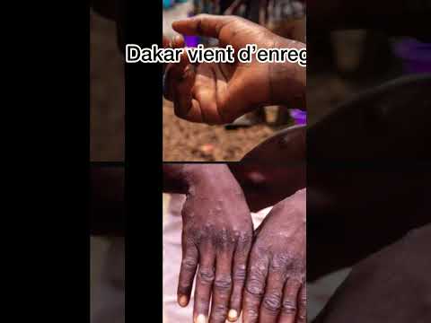 Dakar vient d’enregistrer son premier cas confirmé de l’épidémie de la fièvre du Rift à keur massar