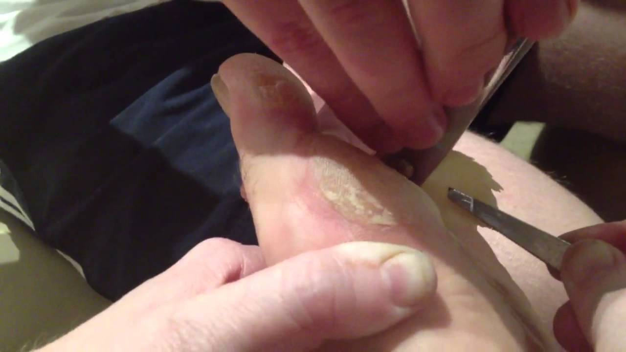 Home Surgery Pussy Callus Removal YouTube