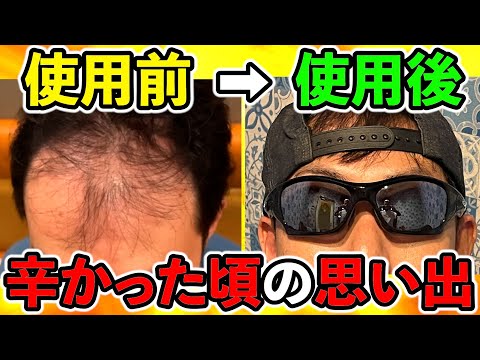 辛かった会社でのエピソードから始まったAGA投薬治療２年目の今、正直な気持ちをお話します。（薄毛、ハゲ、発毛、育毛）