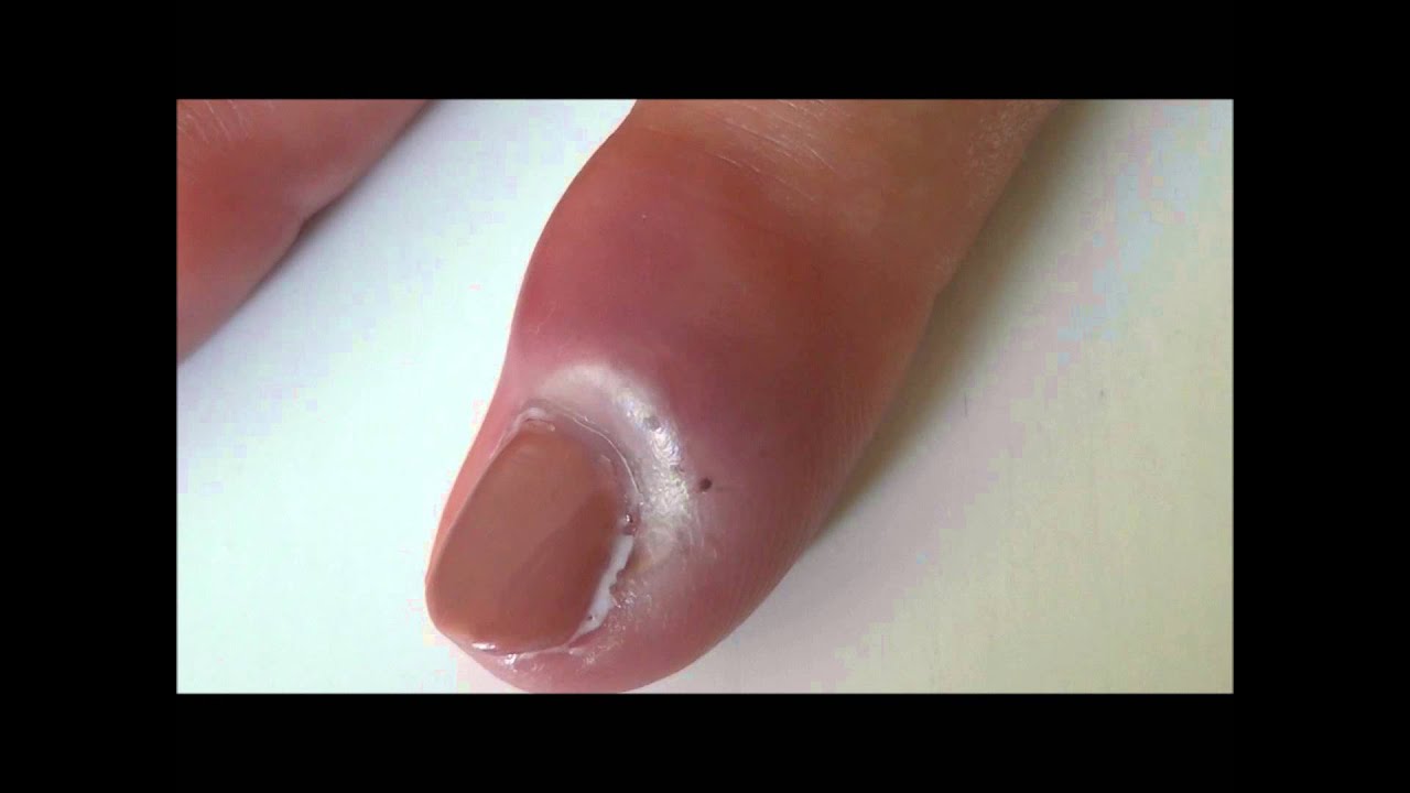 Nail Bed Infection YouTube