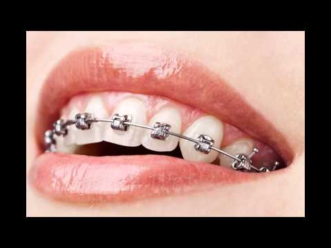 Ceramic Braces Service Oakville by Dentistryinoakville.ca - YouTube