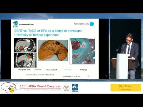 SS09.4 IHPBA Meets ILCA: New Therapies for HCC