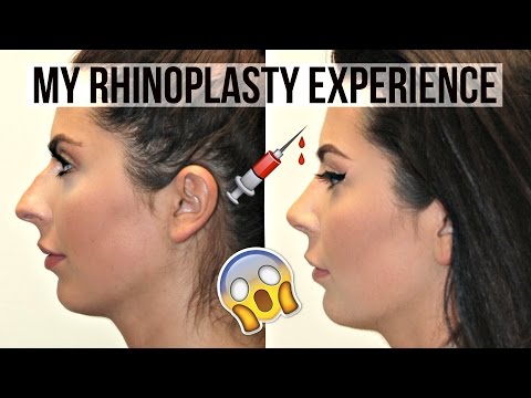 My Rhinoplasty Experience with Eric M. Joseph, M.D. My Rhinoplasty Experience with Eric M. Joseph, M.D.