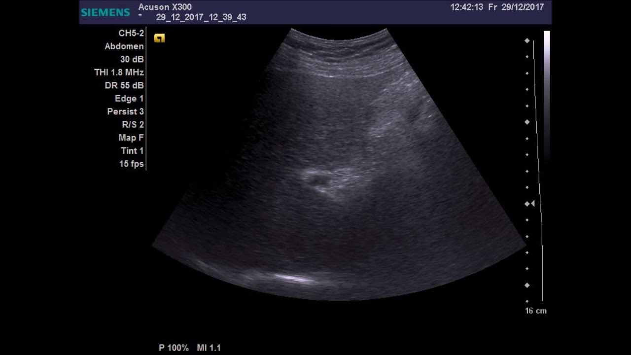 можно увидеть цирроз на узи