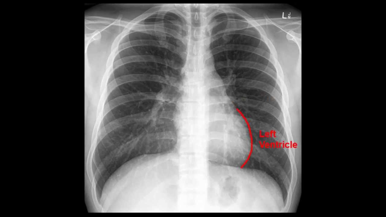 Chest X Ray Interpretation Youtube