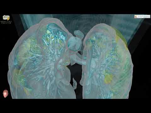 A 360° Virtual Reality fly-through showing the extent of damage to the lungs (yellow) from COVID-19 for a patient seen by Dr. Keith Mortman at George Washington University Hospital.
Made with Surgical Theater technology. A 360° Virtual Reality fly-through showing the extent of damage to the lungs (yellow) from COVID-19 for a patient seen by Dr. Keith Mortman at George Washington University Hospital.
Made with Surgical Theater technology.