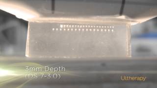 Ultherapy’s Precise Energy Delivery at Three Depths