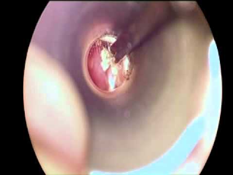 Where Does Ear Wax Come From 24