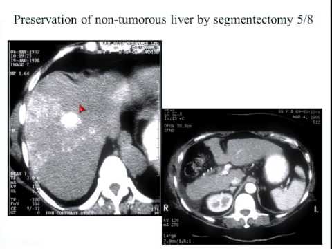 How to Prevent liver failure after hepatectomy 