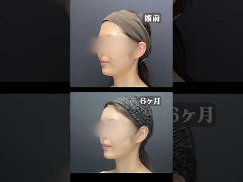 脂肪吸引であご下スッキリ！おでこをまぁるく！ #shorts #脂肪吸引 #東京脂肪吸引クリニック