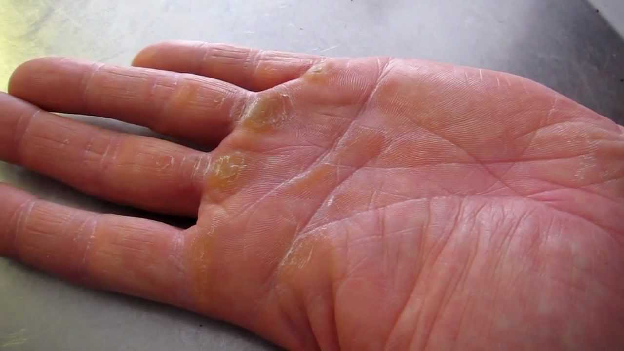 how-to-take-care-of-hard-calluses-on-hands-be-careful-youtube