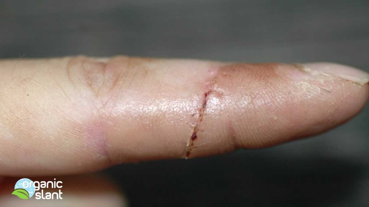 Finger Laceration Time Lapse Healing Organic Slant YouTube