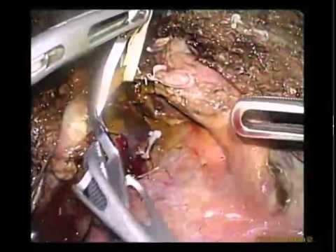 Right Hepatectomy in a Living Donor: the First Pure Laparoscopic Case 