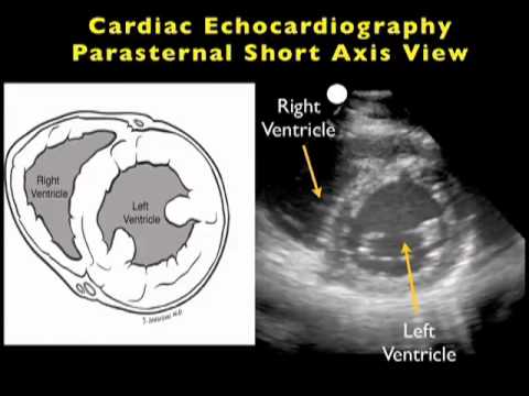 Cardiac Ultrasound - Parasternal Short Axis - SonoSite ... ecg heart diagram 