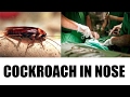 Chennai doctor takes out cockroach 'Alive' from woman's nose