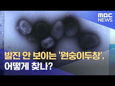 발진 안 보이는 '원숭이두창', 어떻게 찾나? (2022.06.23/뉴스데스크/MBC)