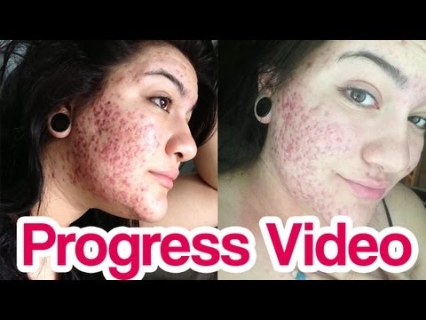 Accutane on-line