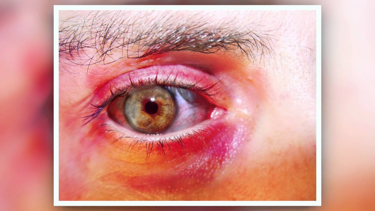 chronic eye tearing in adults