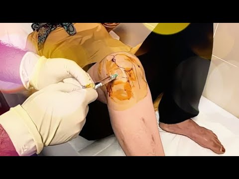 Knee Injection (Viscosupplement)
