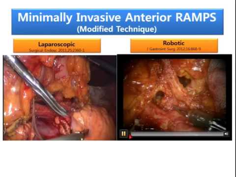 Laparoscopic (minimally invasive) RAMPS for pancreatic cancer 