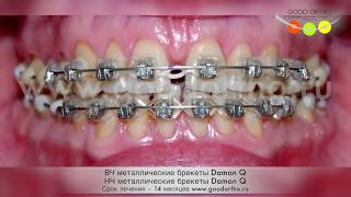 Как убрать промежуток между передними зубами при помощи брекетов?