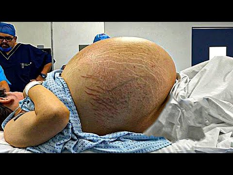 7 Embarazos EXTRAÑOS con Resultados Inesperados